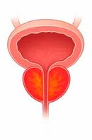 Prostatas dziedzera iekaisums